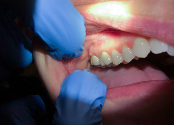 Best Emergency Gum Treatment in Ronkonkoma, NY